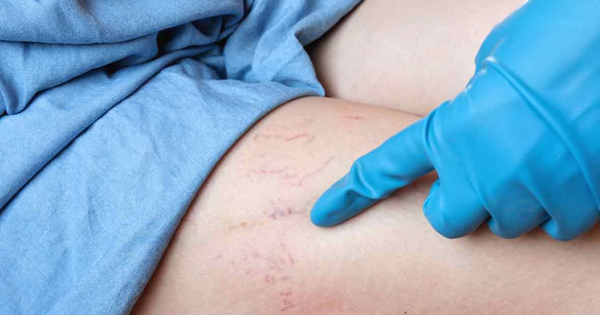 pathologies veineuses